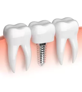 Implantes dentales: que son y cuántos tipos existen. - Clínica dental Sevilla Implantes dentales: que son y cuántos tipos existen. - Clínica dental en Sevilla