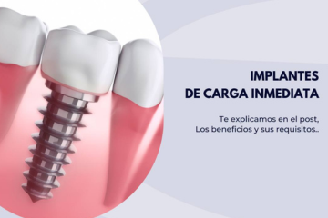 Todo lo que necesitas saber los implantes de carga inmediata. - Clínica dental en Sevilla