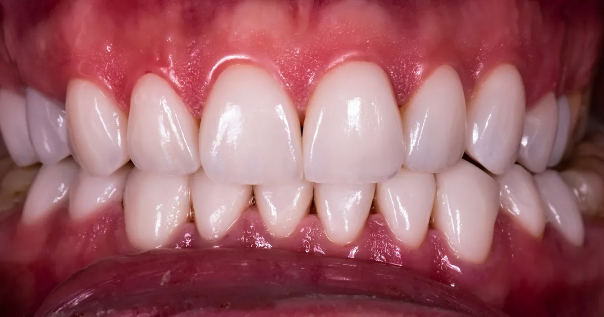 Estética Dental - Clínica dental en Sevilla