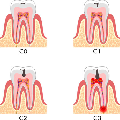 Endodoncia - Clínica dental en Sevilla