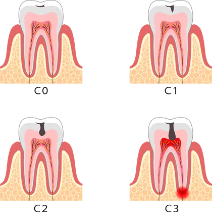 Endodoncia - Clínica dental en Sevilla