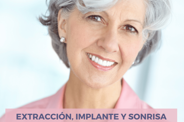 ¿Conoces los implantes de carga inmediata? - Clínica dental en Sevilla