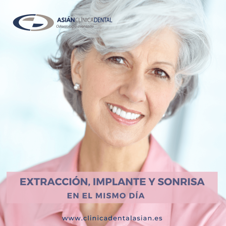 ¿Conoces los implantes de carga inmediata? - Clínica dental en Sevilla