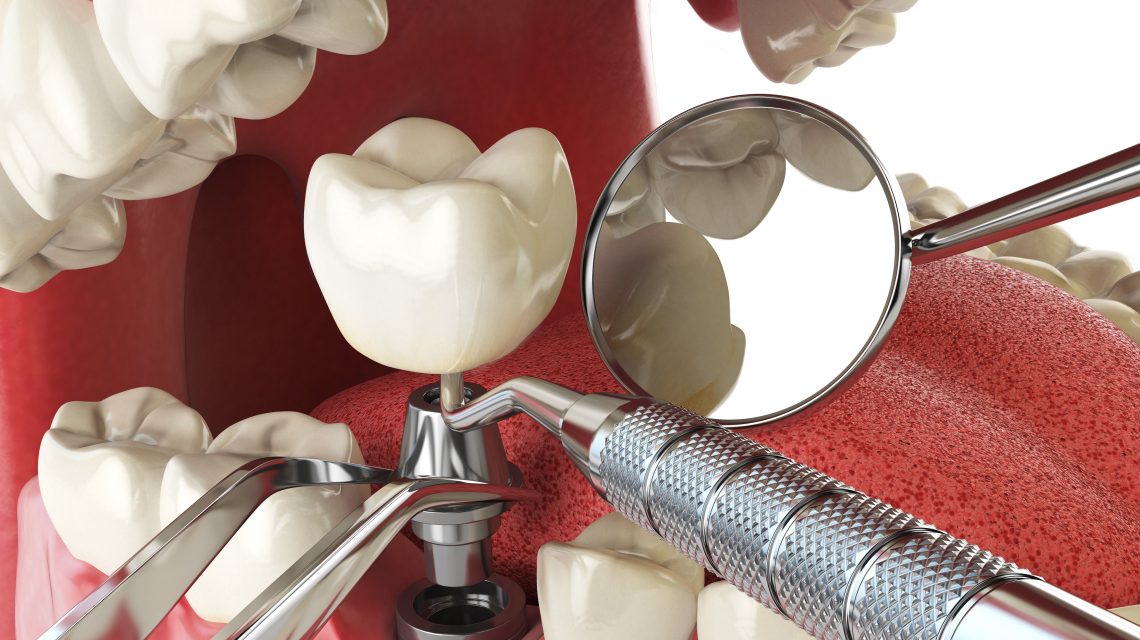 Implantes dentales: que son y cuántos tipos existen. - Clínica dental en Sevilla