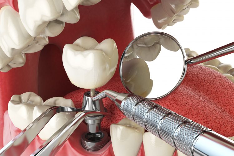 Implantología - Clínica dental en Sevilla