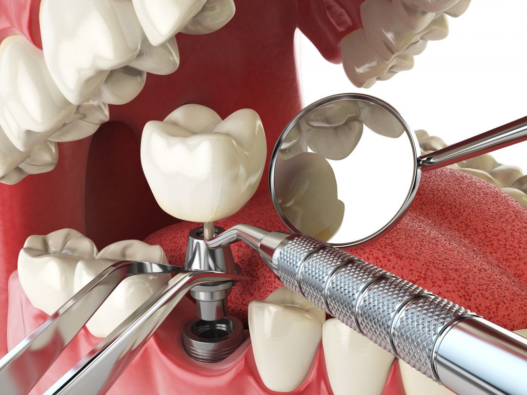 Implantes dentales: que son y cuántos tipos existen. - Clínica dental en Sevilla