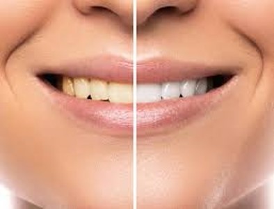 Claves para conseguir un buen blanqueamiento dental - Clínica dental en Sevilla