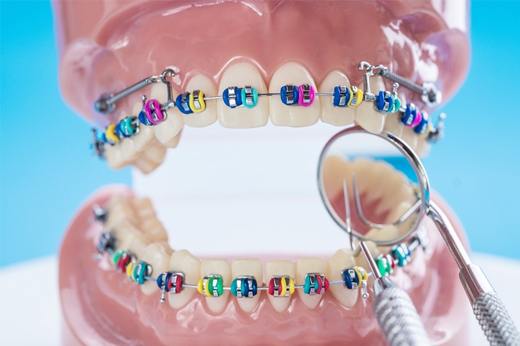 ¿Cuándo es necesaria una ortodoncia? - Clínica dental en Sevilla