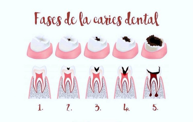 Fases de la caries. ¿Porqué no siempre duele? - Clínica dental en Sevilla