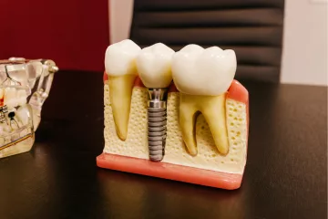 ¿Cuándo es el momento de realizarte un implante dental? - Clínica dental en Sevilla
