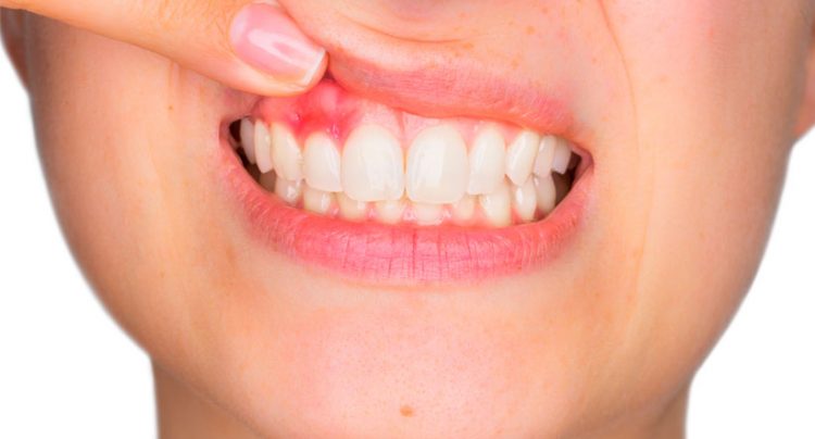 ¿Enfermedad periodontal? - Clínica dental en Sevilla