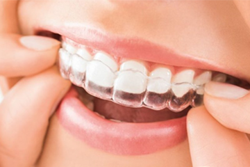 Retendedores de ortodoncia, ¿para qué sirven? - Clínica dental en Sevilla